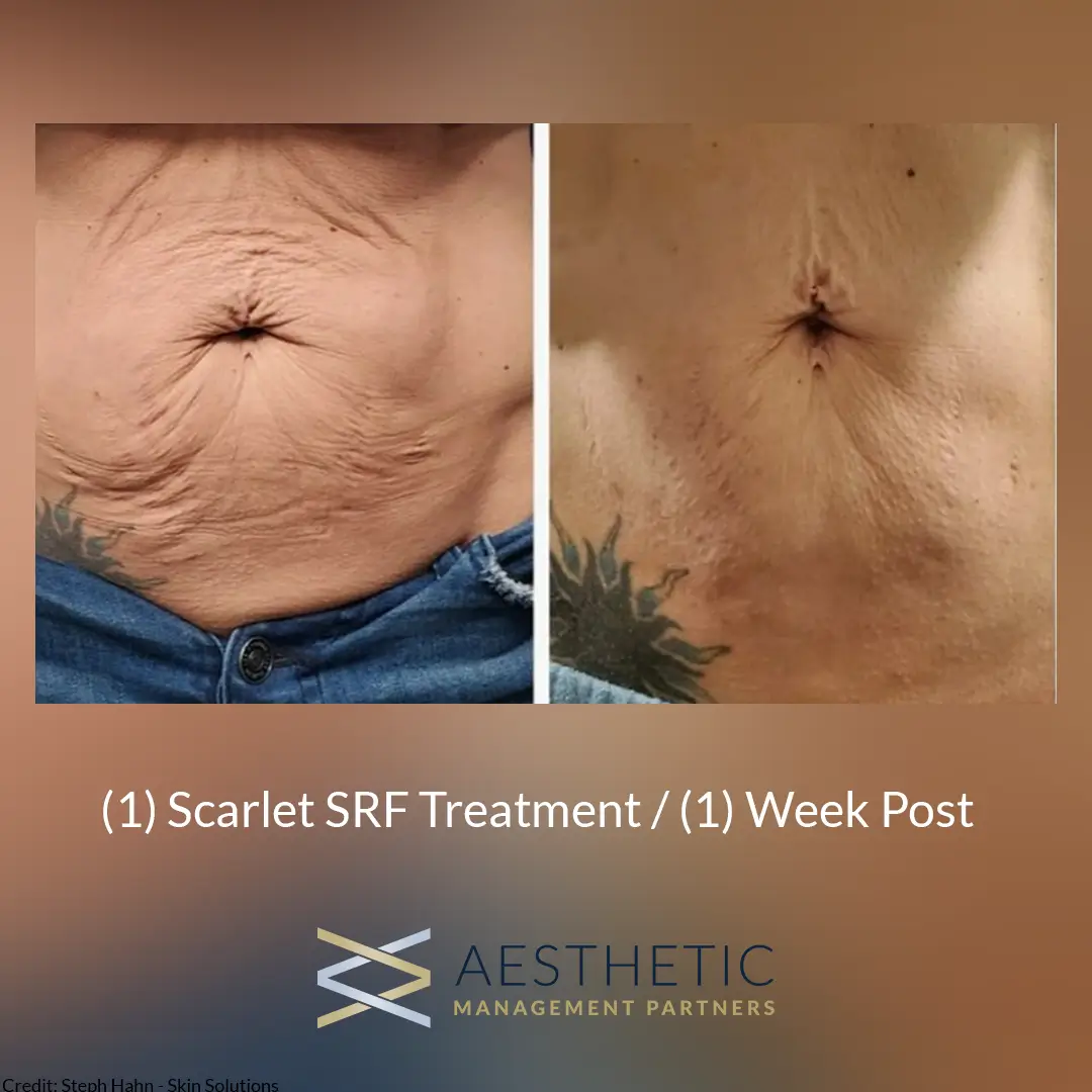 A before and after image of a belly after scarlet srf treatment