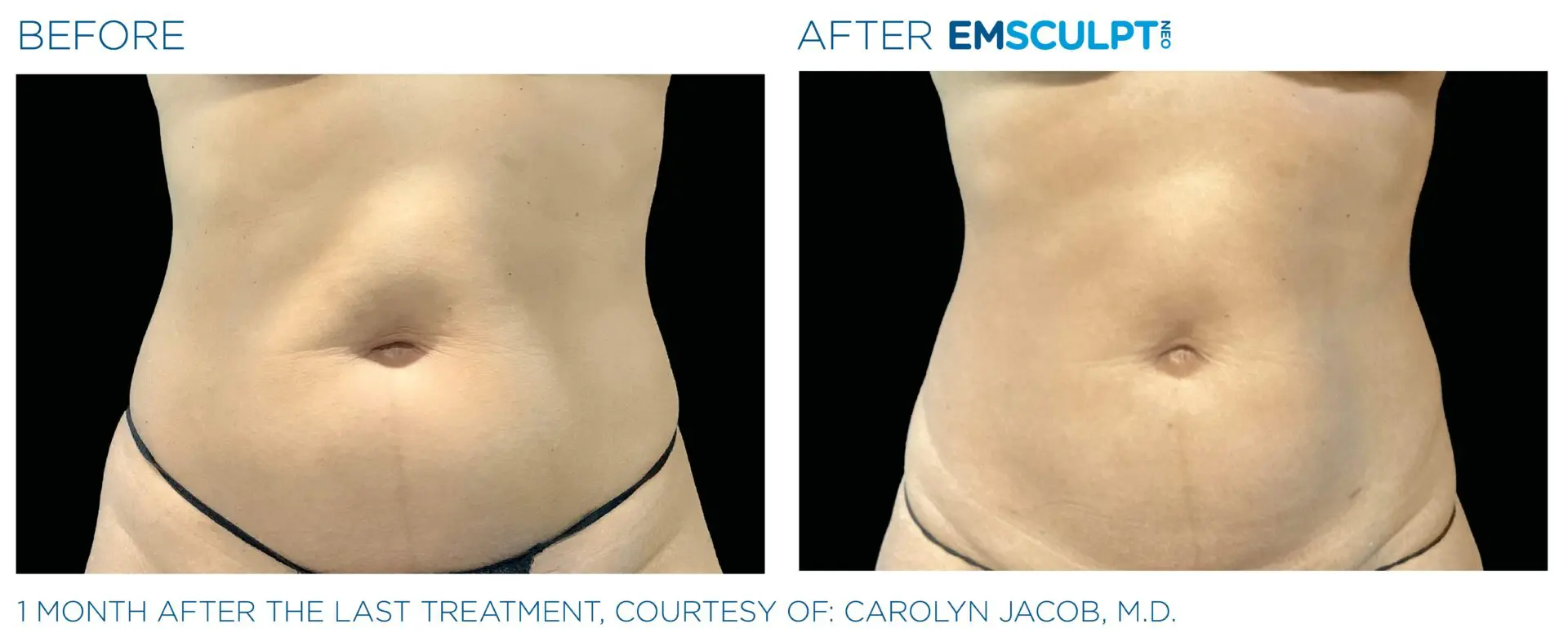 Emsculpt abd