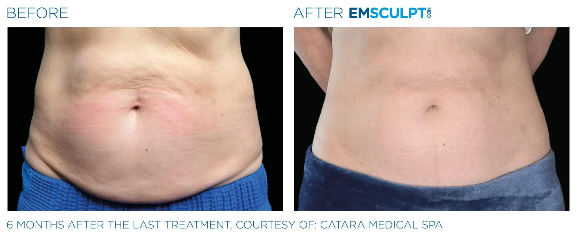 Emsculpt body