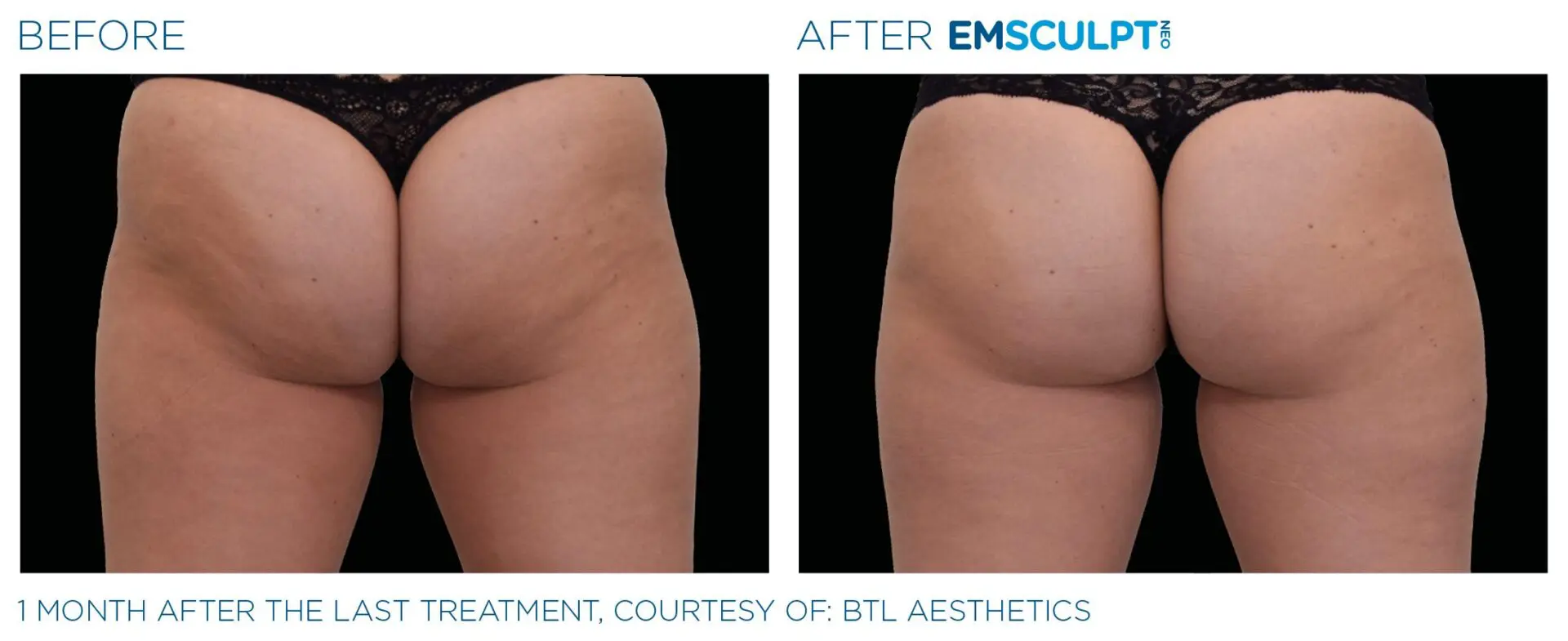 Emsculpt butt